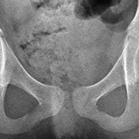 radiografía de la enfermedad de Legg-CalvéPerthes