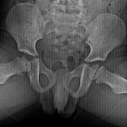 RX axial - Perthes fase de necrosis