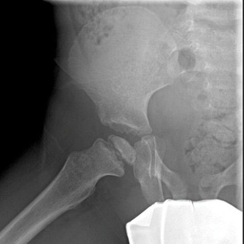 Evolución radiológica de un caso de Perthes a los 3 meses