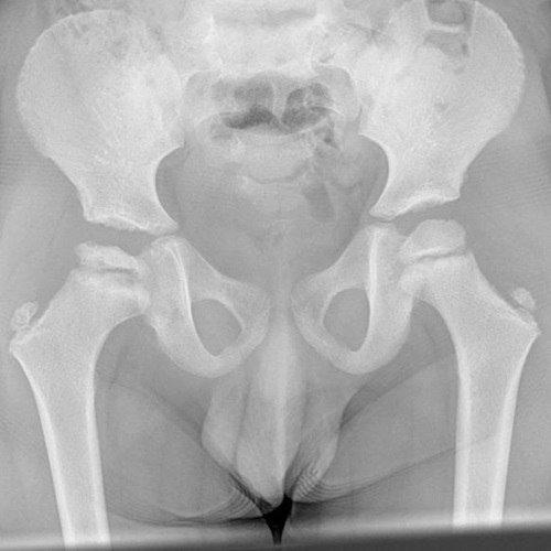 Evolución radiológica de un caso de Perthes. Fase de fragmentación.