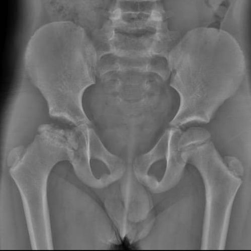 Perthes RX  AP 