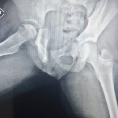 caso de Perthes derecho en niña. RX AXIAL. Evolución radiológica.