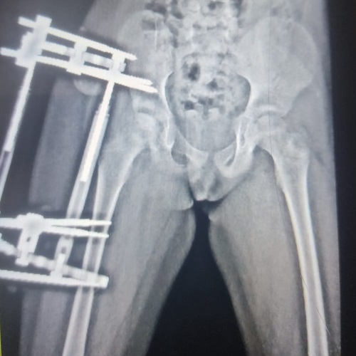 Artrodiastasis con fijador externo