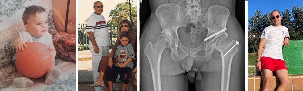 Armando - osteotomía de Chiari