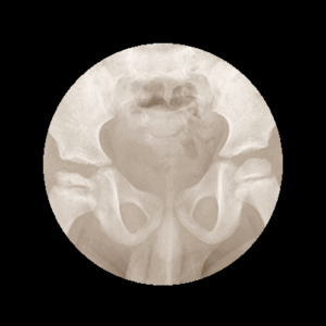 radiografía Perthes