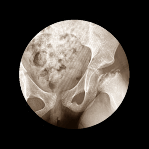 radiografía Perthes